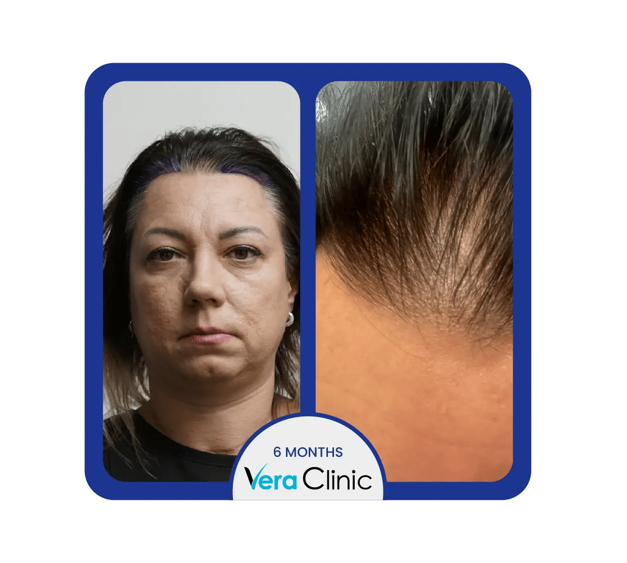 Resultados antes e depois do transplante capilar feminino, mostrando a densidade capilar restaurada e o desenho natural da linha do cabelo na Vera Clinic, Turquia.