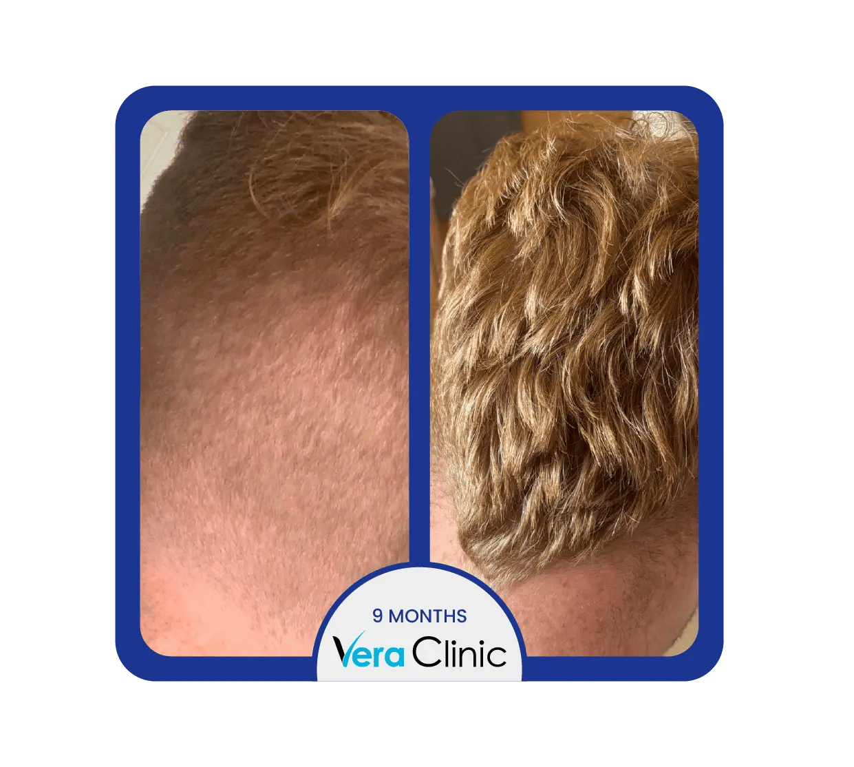 Resultados antes e depois de 1500 enxertos capilares na Clínica Vera, na Turquia, destacando o aumento da densidade frontal e o crescimento natural do cabelo.
