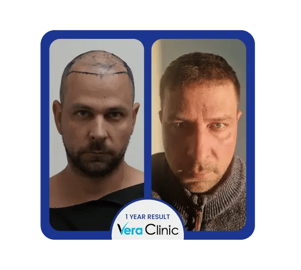 Resultados antes e depois de um transplante capilar de 2000 enxertos na Vera Clinic, em Istambul, mostrando uma cobertura mais completa no meio do couro cabeludo e um crescimento visível.
