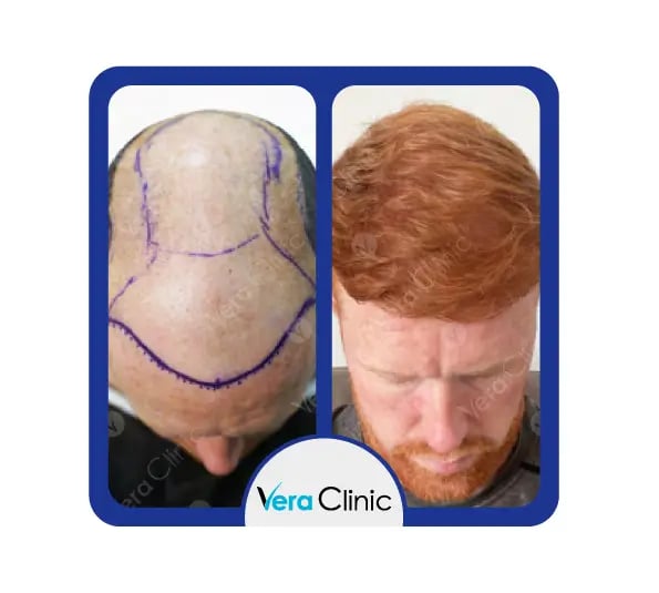 Transplante capilar antes e depois de 3000 enxertos na Vera Clinic, Istambul, demonstrando cobertura avançada e restauração natural da coroa.