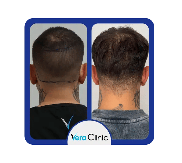 Resultados da área doadora DHI na Clínica Vera, em Istambul, mostrando zonas de extração limpas e crescimento uniforme do cabelo após o implante.