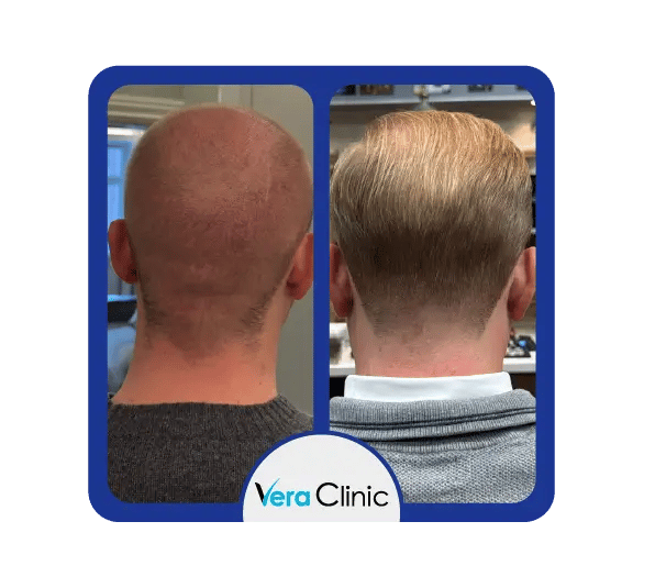 Área doadora Sapphire FUE antes e depois na Clínica Vera, demonstrando cicatrização suave, trauma mínimo e crescimento natural após a extração.