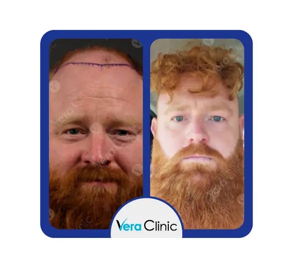 Resultados antes e depois de um transplante capilar de 4500 enxertos na Clínica Vera, em Istambul, mostrando uma restauração capilar completa e uma forte melhoria na densidade.