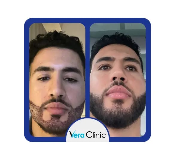 Resultados antes e depois do transplante de barba, mostrando pelos faciais mais espessos e linha da barba definida após o transplante de pelos faciais na Turquia, Vera Clinic.
