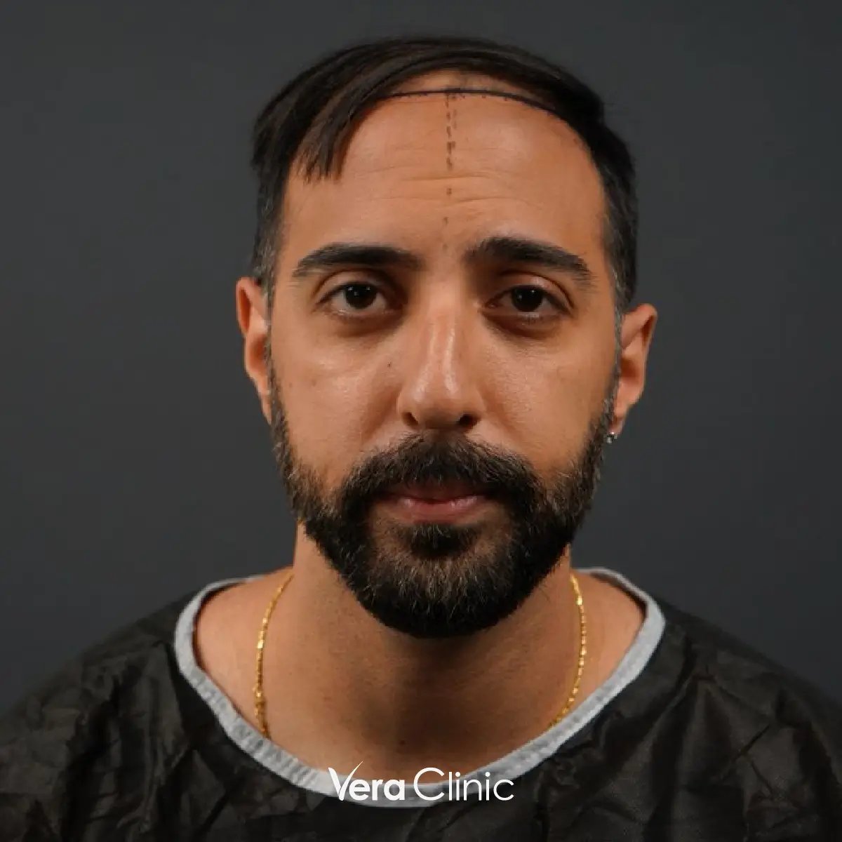 Amit, celebridade após transplante capilar na Vera Clinic, Istambul, mostrando um melhor design da linha do cabelo e um crescimento mais denso.