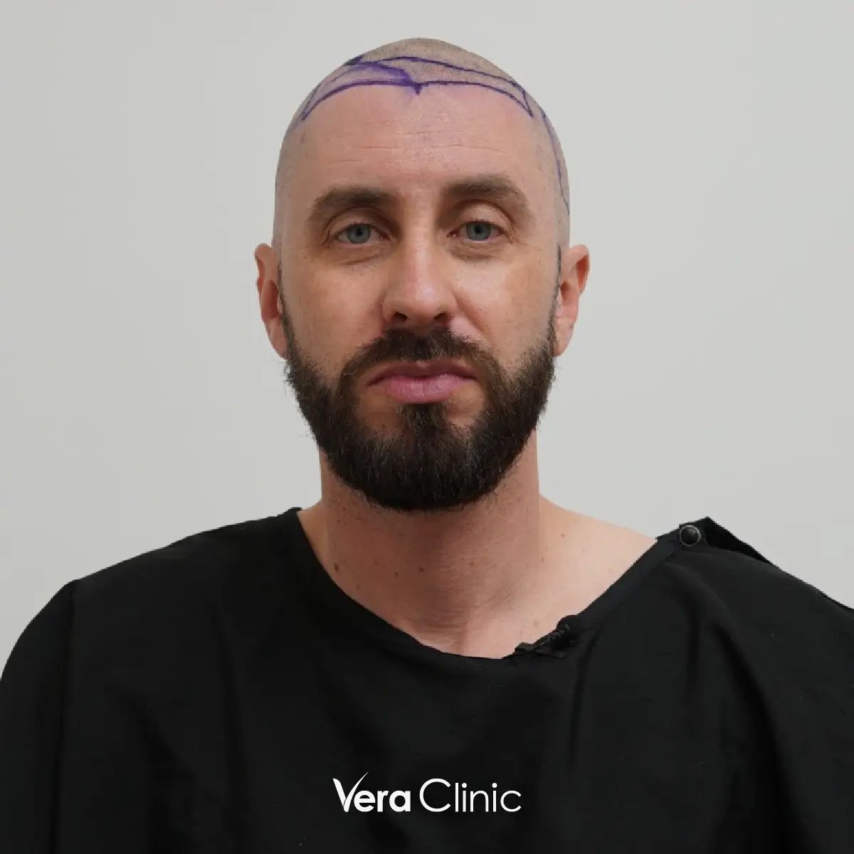 Jamie Perkins, celebridade após transplante capilar na Vera Clinic, na Turquia, mostrando crescimento natural do cabelo e aparência mais espessa.