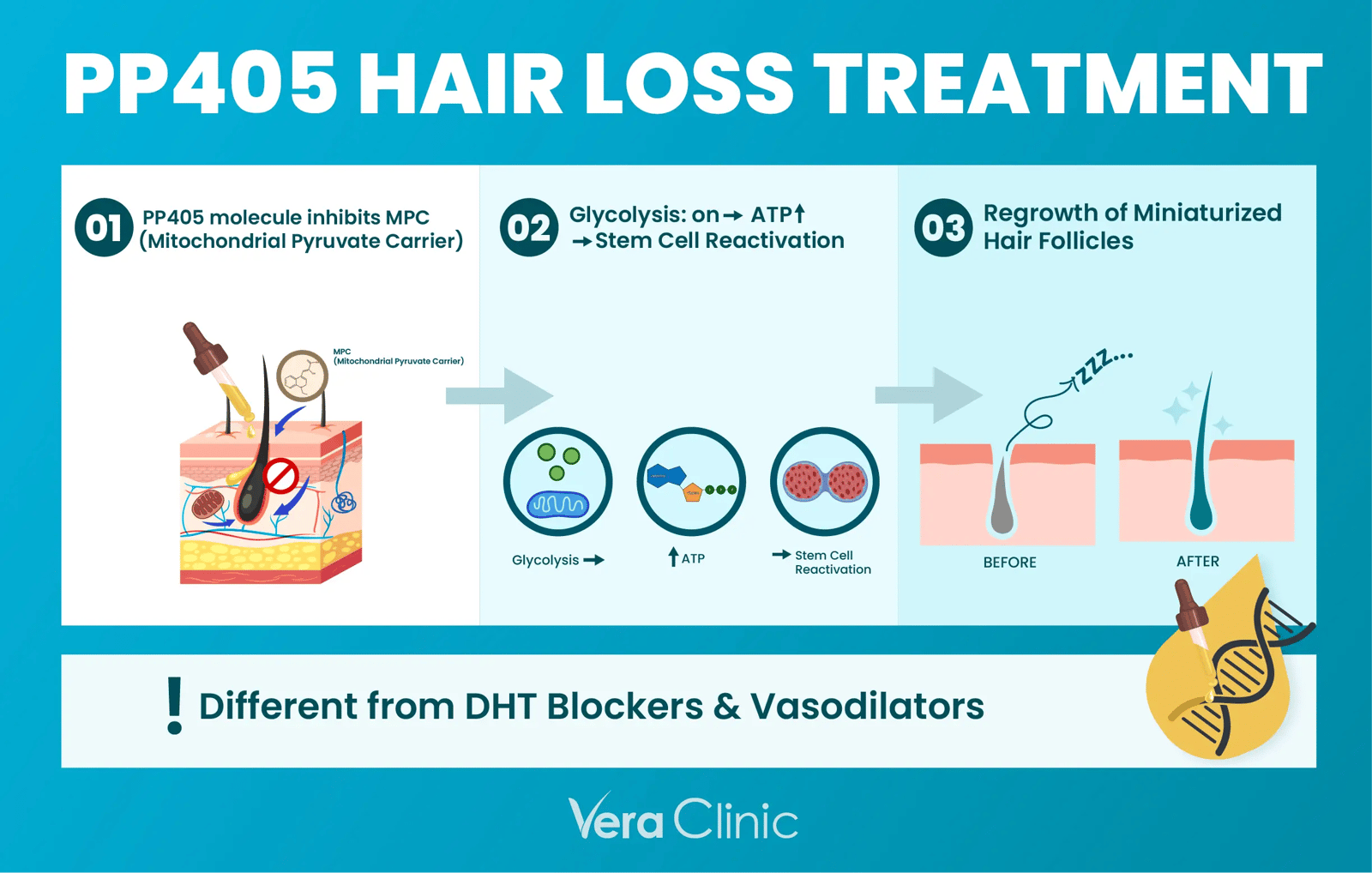 Minoxidil PP405 Hair Loss Treatment
