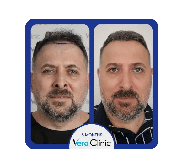 Resultados antes e depois do transplante capilar Sapphire FUE na Clínica Vera, mostrando uma linha capilar natural e uma elevada taxa de sobrevivência dos enxertos.