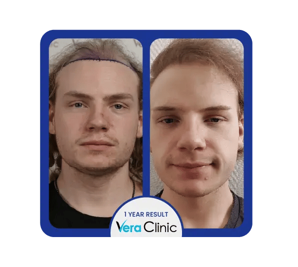 Resultados antes e depois do transplante capilar Sapphire FUE na Clínica Vera, mostrando um desenho preciso da linha do cabelo e cicatrização sem marcas.