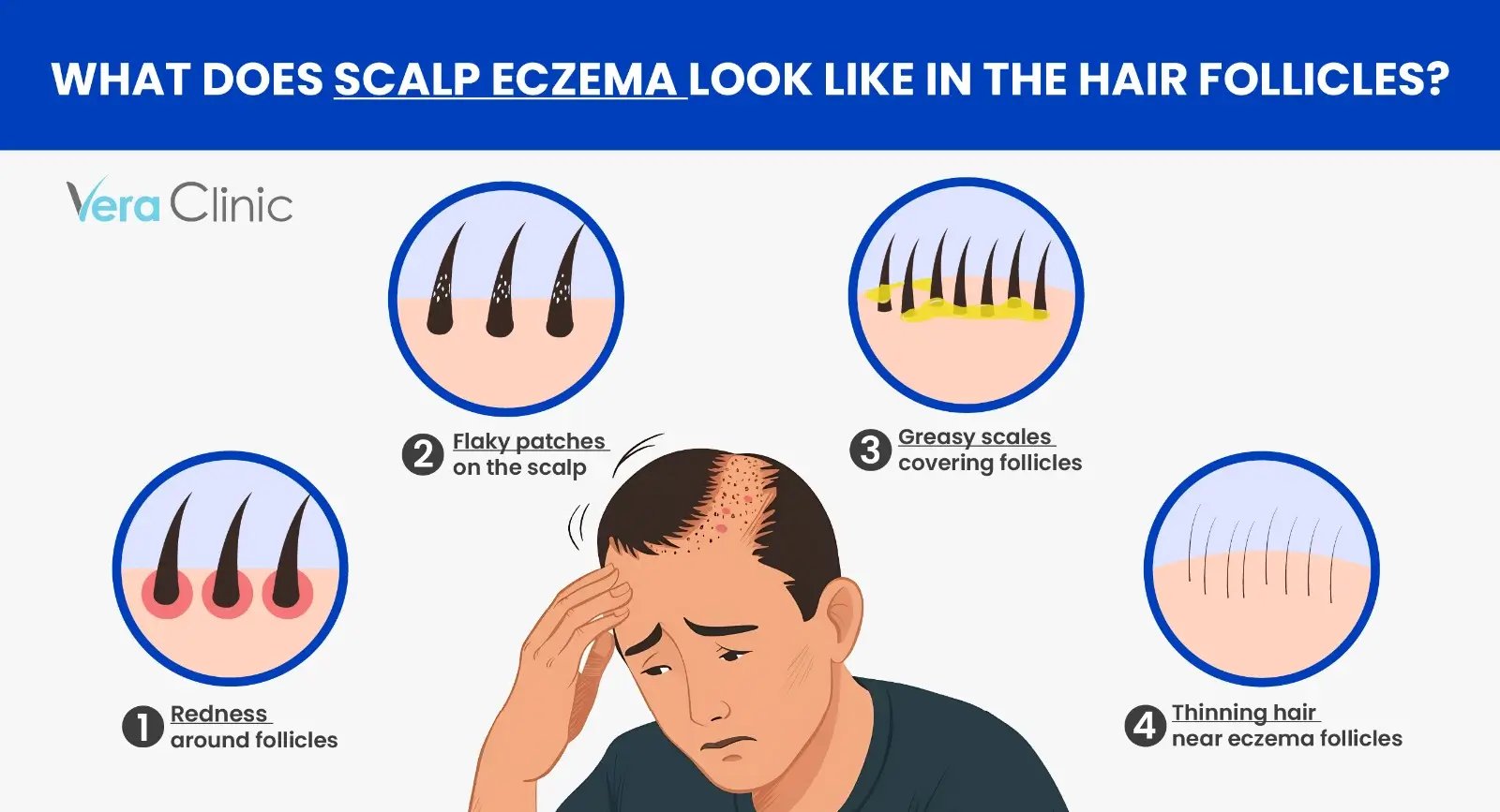 What Does Scalp Eczema Look Like in the Hair Follicles
