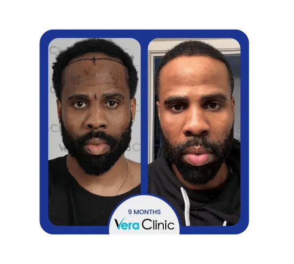 Antes e depois do transplante capilar afro na Vera Clinic, em Istambul, demonstrando uma linha capilar mais cheia e crescimento uniforme para tipos de cabelos cacheados.