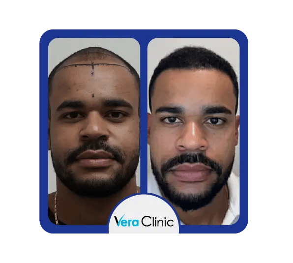Resultados antes e depois do transplante capilar afro na Clínica Vera, na Turquia, mostrando a restauração do padrão natural dos caracóis e a melhoria da densidade capilar.