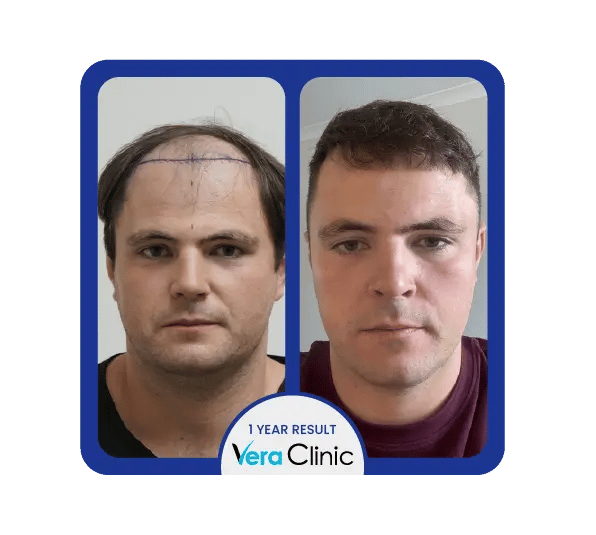 Transplante capilar DHI antes e depois na Clínica Vera, Istambul, destacando a melhoria na espessura e cobertura do cabelo