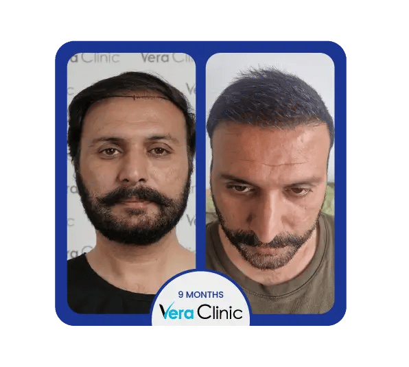 dhi antes e depois, mostrando um aumento visível no volume e no padrão de crescimento do cabelo na Clínica Vera