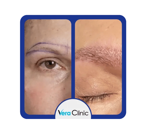 Antes e depois do transplante de sobrancelhas na Turquia, a Vera Clinic destaca o crescimento de sobrancelhas mais cheias e simétricas.