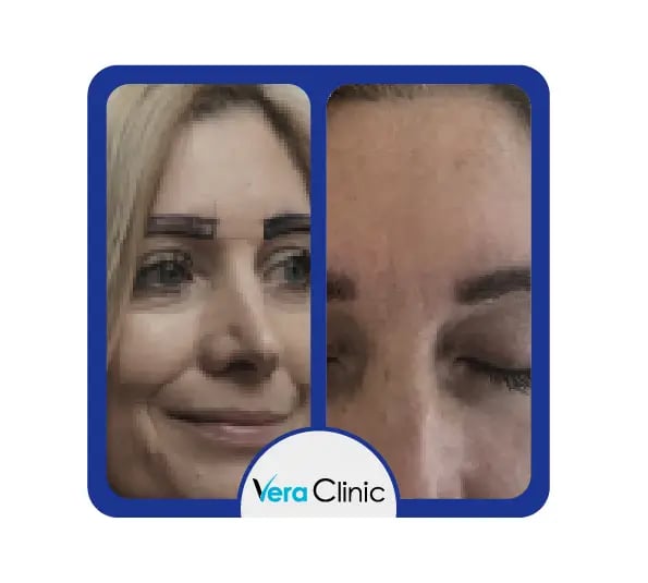Transplante de sobrancelhas na Turquia: resultados antes e depois mostrando a restauração natural da forma e densidade das sobrancelhas na Clínica Vera