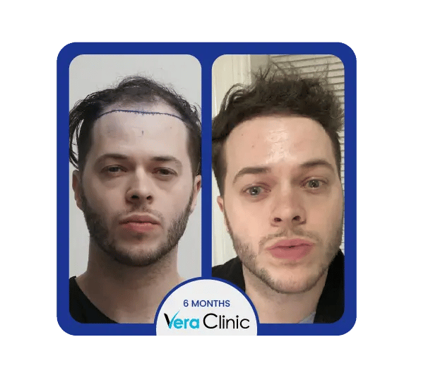 Comparação antes e depois do transplante capilar FUE na Clínica Vera, em Istambul, demonstrando a restauração natural da linha do cabelo.