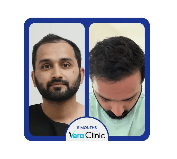 Resultados do transplante capilar na Vera Clinic, Turquia, mostrando uma melhoria significativa na densidade capilar após a cirurgia.