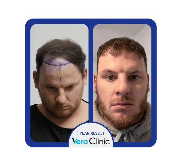 Fotos de antes e depois do transplante capilar com células estaminais na Clínica Vera, mostrando um crescimento capilar melhorado e folículos mais fortes.
