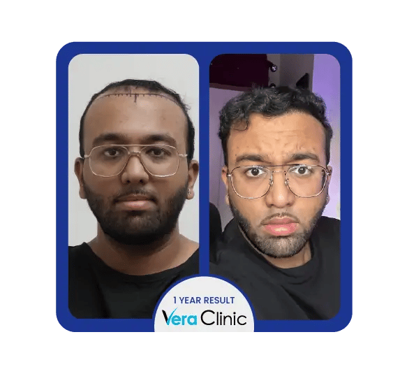 Comparação antes e depois da restauração capilar com células estaminais, mostrando uma recuperação mais rápida e uma melhoria na saúde do couro cabeludo na Clínica Vera, na Turquia.