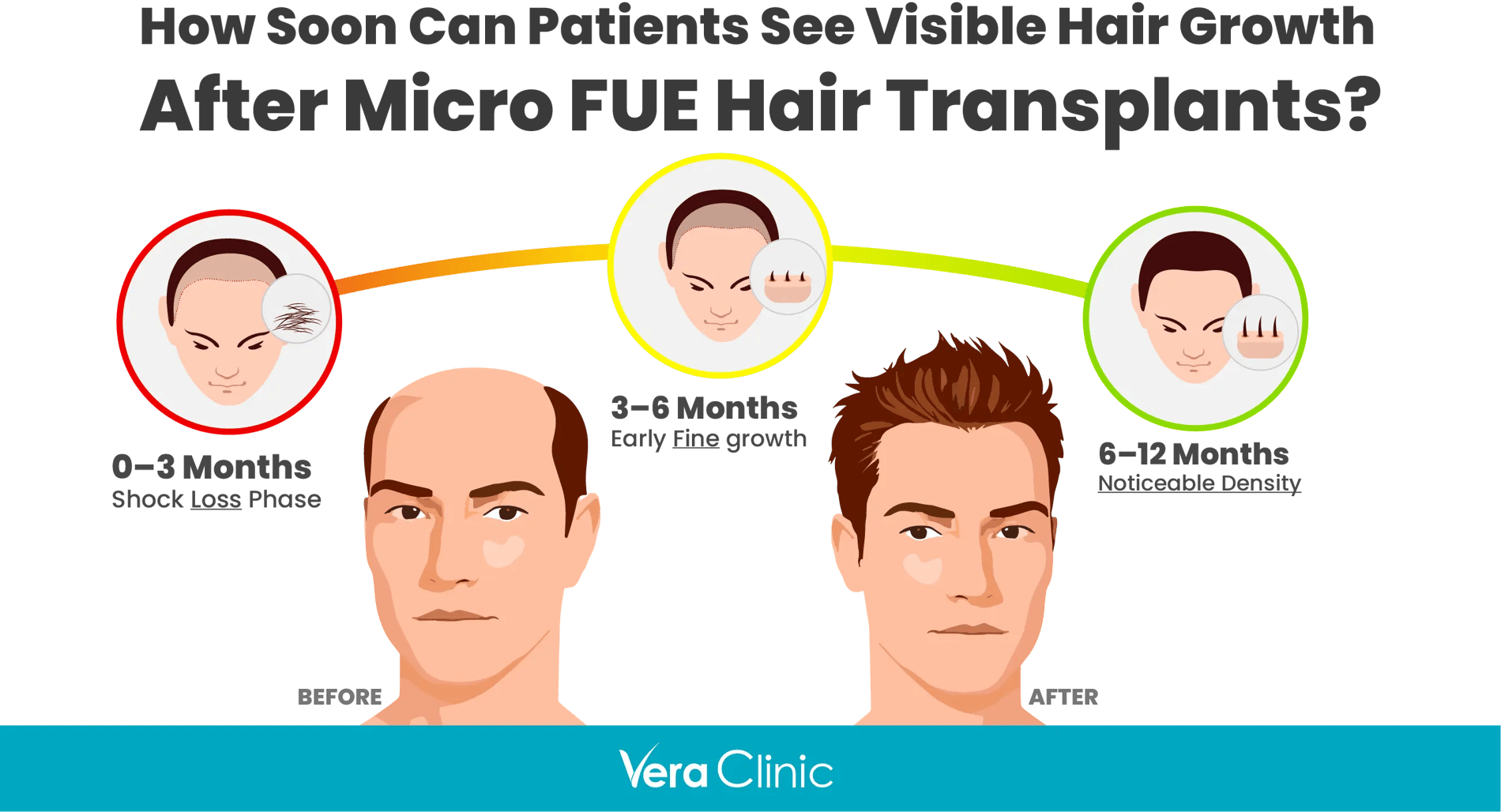 AFTER HAİR TRANSPLANT How Soon Can Patients See Visible Hair Growth After Micro FUE Hair Transplants