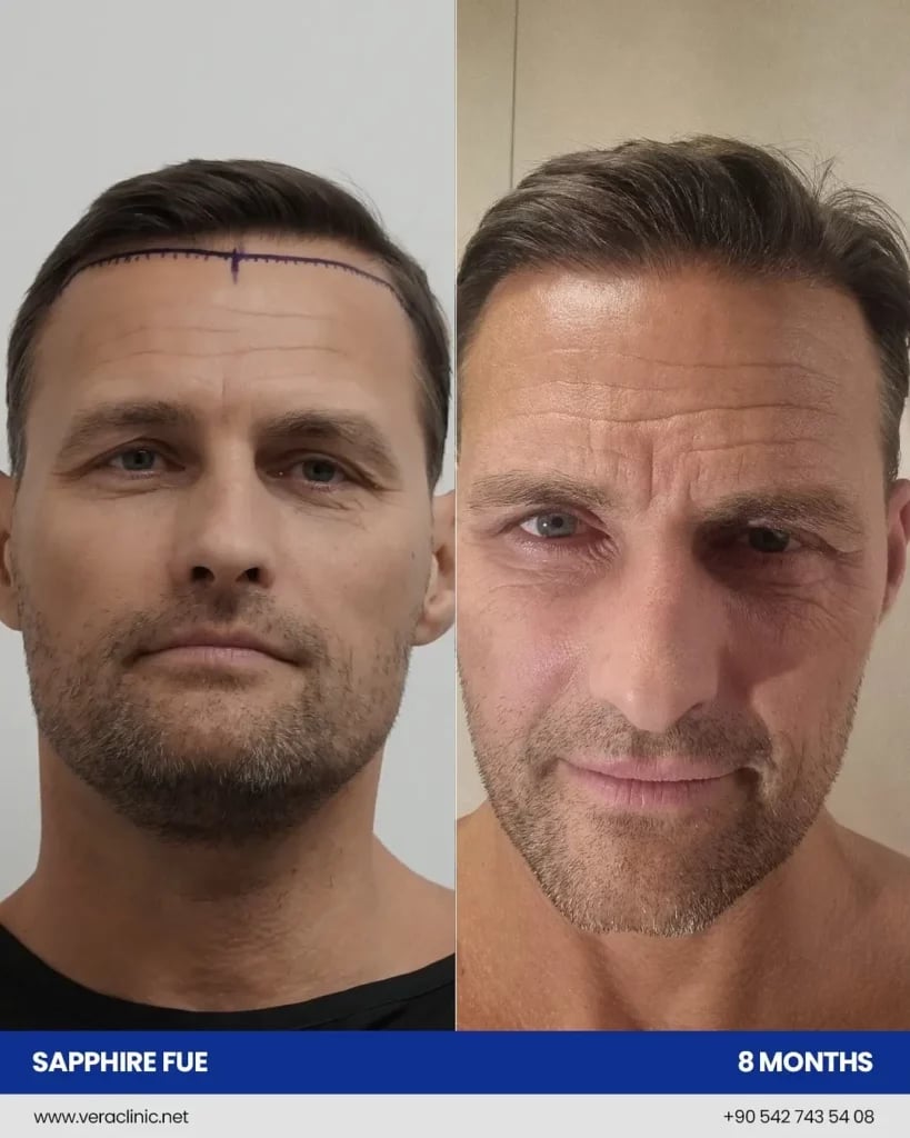 Exosome Hair Therapy Before and After Results Exosome therapy before and after at Vera Clinic showing improved hair density and scalp vitality.