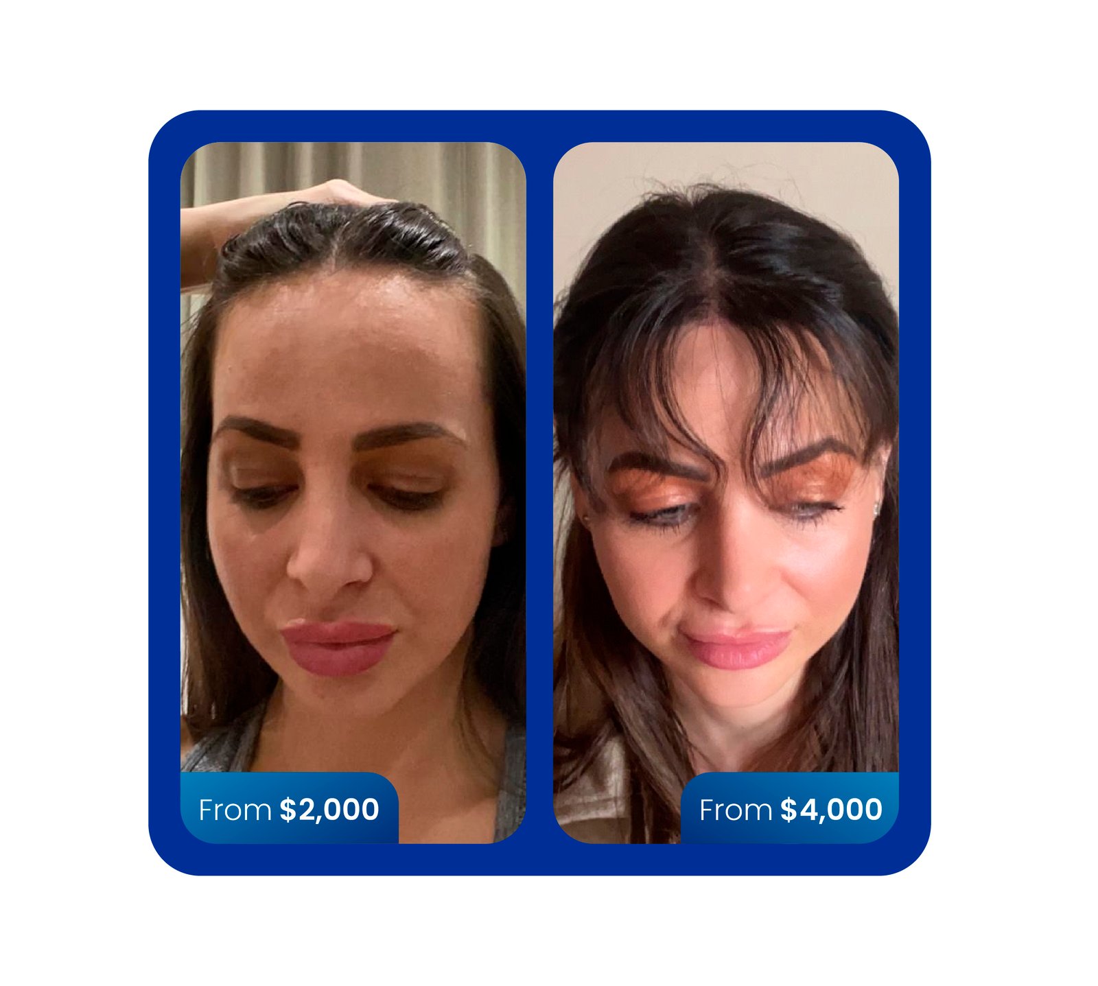 FUE hair transplant 5000 grafts before and after turkey cost