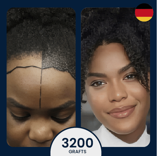 3750 female hair transplant, afro hair, hairline