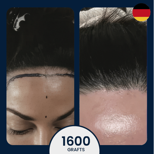 4500 female hair transplant hairline