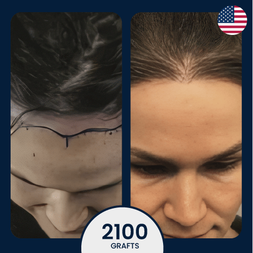 3400 female hair transplant, unshaved DHI