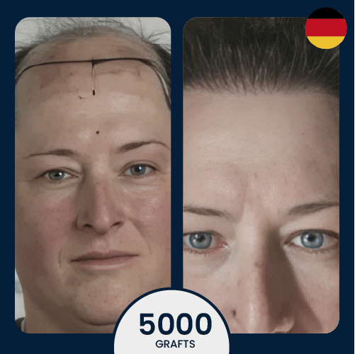 6000 female hair transplant full coverage for androgenetic alopecia