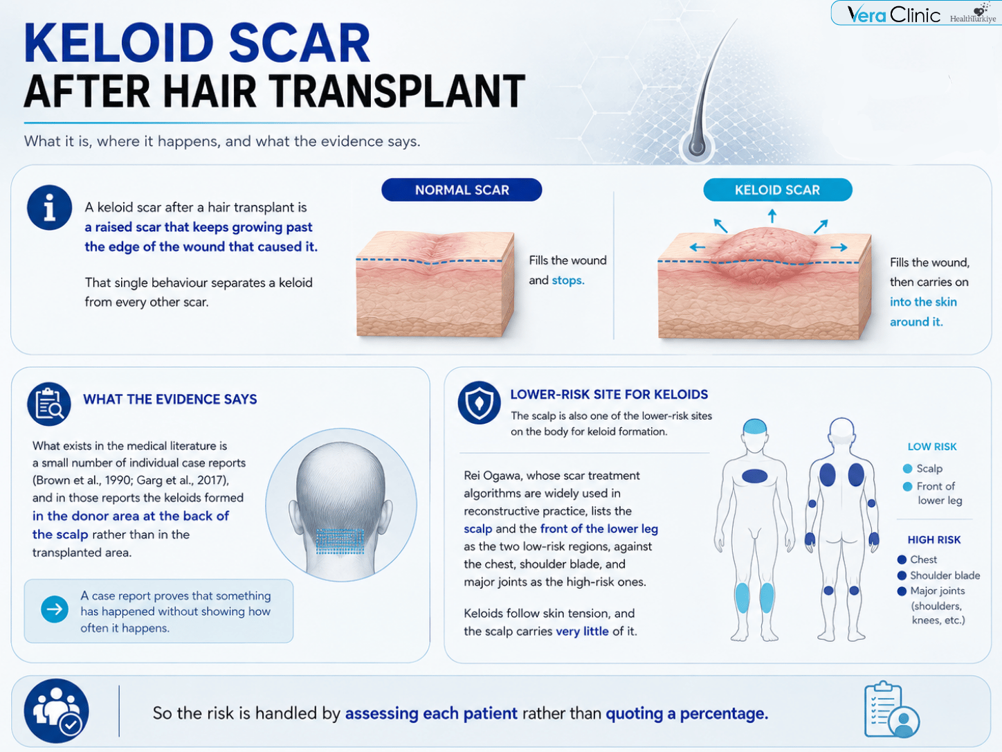 Hair Transplant Keloid Scar