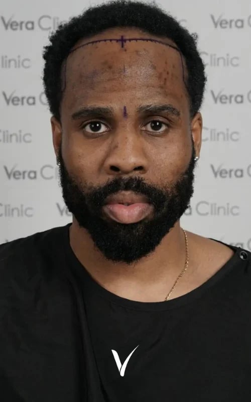 Afro-Haartransplantationspatient vor der Operation, 3.605 Transplantate