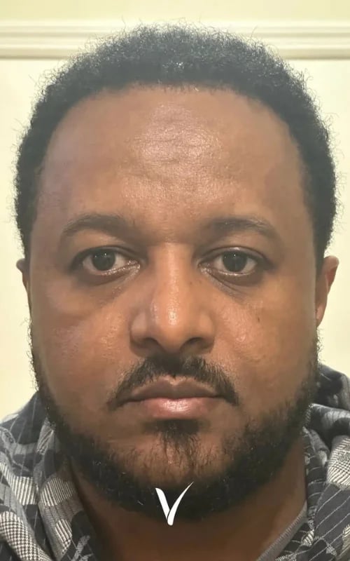 Derselbe Patient 12 Monate nach einer Afro-Haartransplantation mit 5.880 Transplantaten in der Vera Clinic