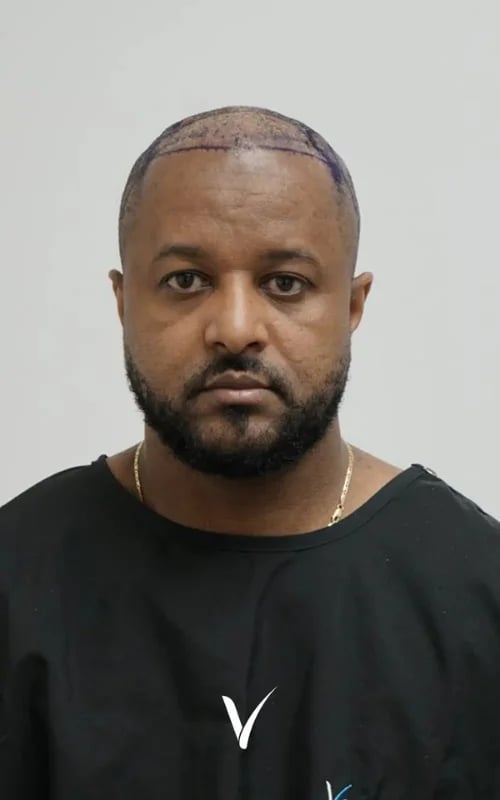 Afro-Haartransplantationspatient vor der Operation, 5.880 Transplantate