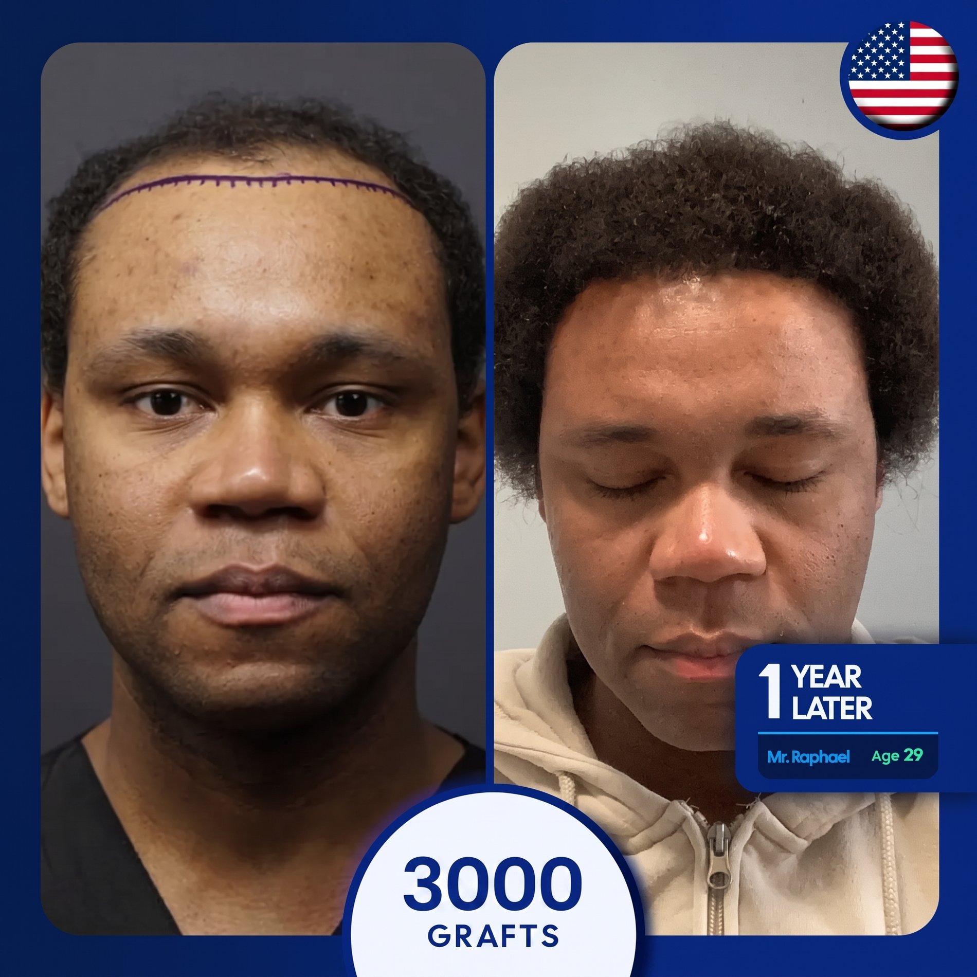 The same man with a full, dense, and well-defined Mustache after a successful transplant.