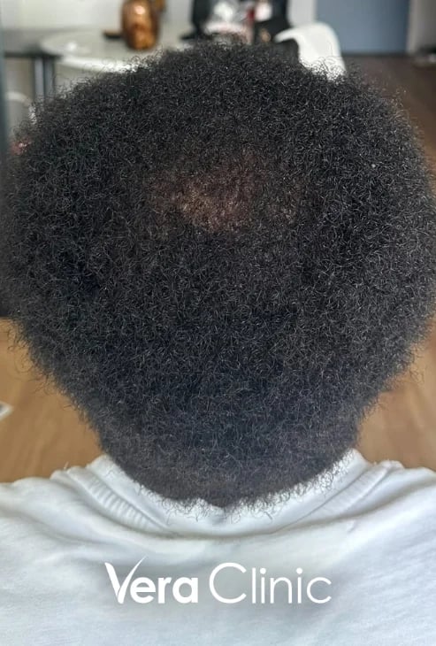 Tonsurbereich drei Monate nach einer Afro-Haartransplantation, erstes Nachwachsen