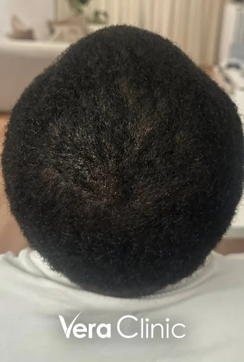 Tonsurbereich acht Monate nach einer Afro-Haartransplantation, Deckung füllt sich auf
