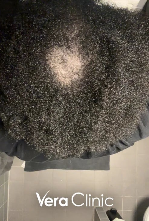 Tonsurbereich vor einer Afro-Haartransplantation, 875 Transplantate geplant