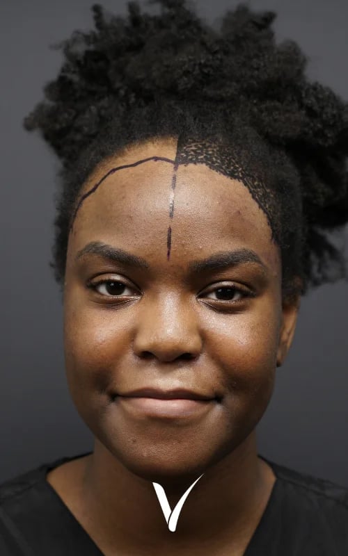 Afro-Haartransplantationspatientin vor der Operation, 2.100 Transplantate