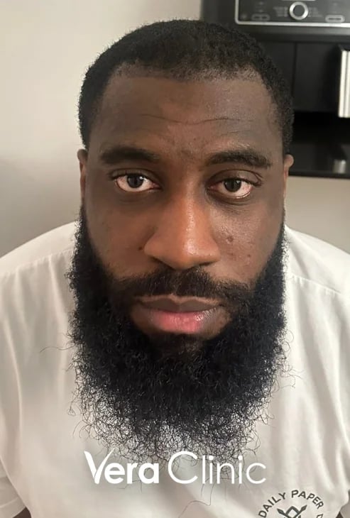 Haarlinienzone drei Monate nach einer Afro-Haartransplantation, erstes Nachwachsen