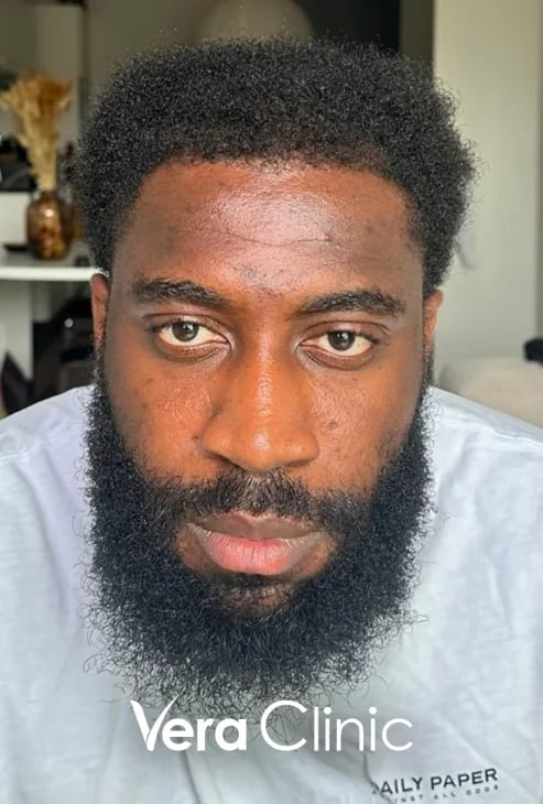 Haarlinienzone acht Monate nach einer Afro-Haartransplantation, Dichte etabliert