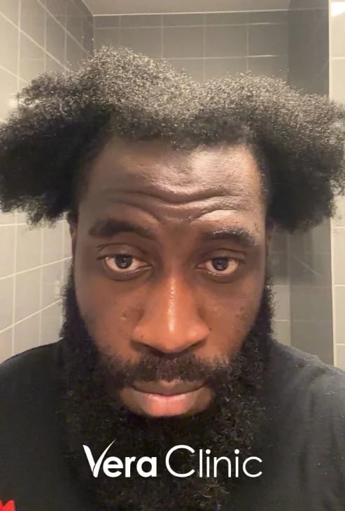 Haarlinienzone vor einer Afro-Haartransplantation, 875 Transplantate geplant