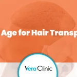 best age for hair transplant